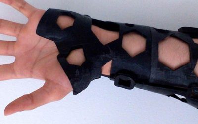 More Comfortable 3D Printed Casts
